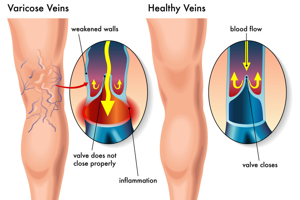 Вены На Ногах Болезни
