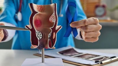 ESMO: ведение пациентов с локализованным раком прямой кишки