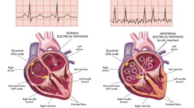 Метформин снижал частоту рецидивов фибрилляции предсердий