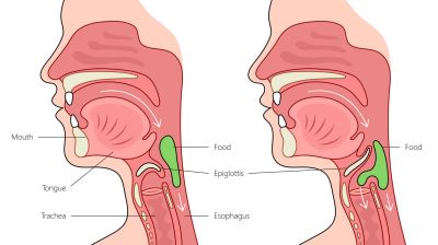UEGS/ESNM: ведение пациентов с дисфагией пищевода и ротоглотки