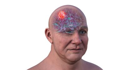 Сфокусированный ультразвук позволил доставить темозоломид через гематоэнцефалический барьер