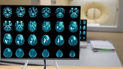 Ингибиторы протонной помпы ухудшали выживаемость у пациентов с глиобластомой