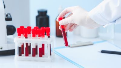 Найден способ спрогнозировать исходы ишемического инсульта по анализу крови