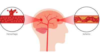 Обновлены рекомендации по раннему лечению ишемического инсульта