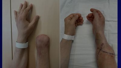 Первую в России пересадку обеих кистей рук от донора провели в НИИ им. Склифосовского