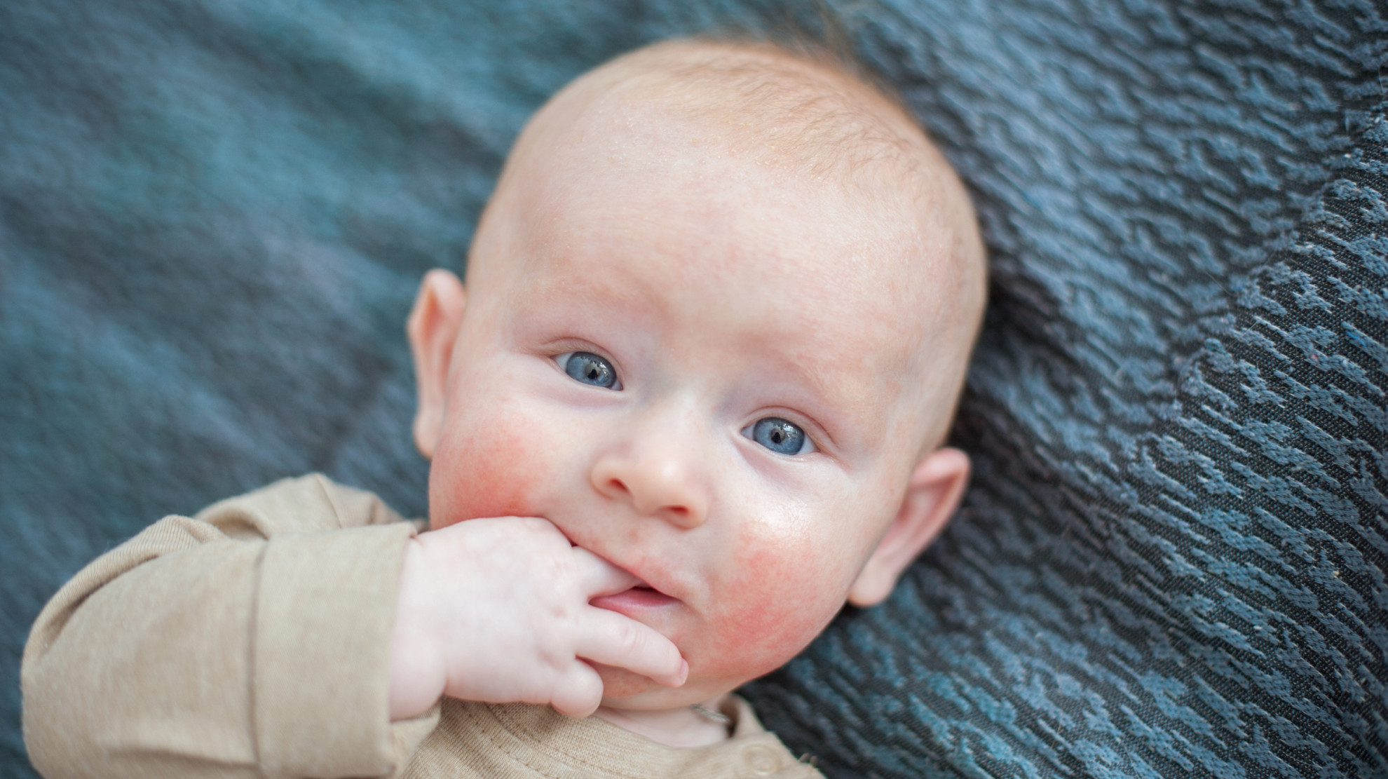 NICE: атопический дерматит у детей