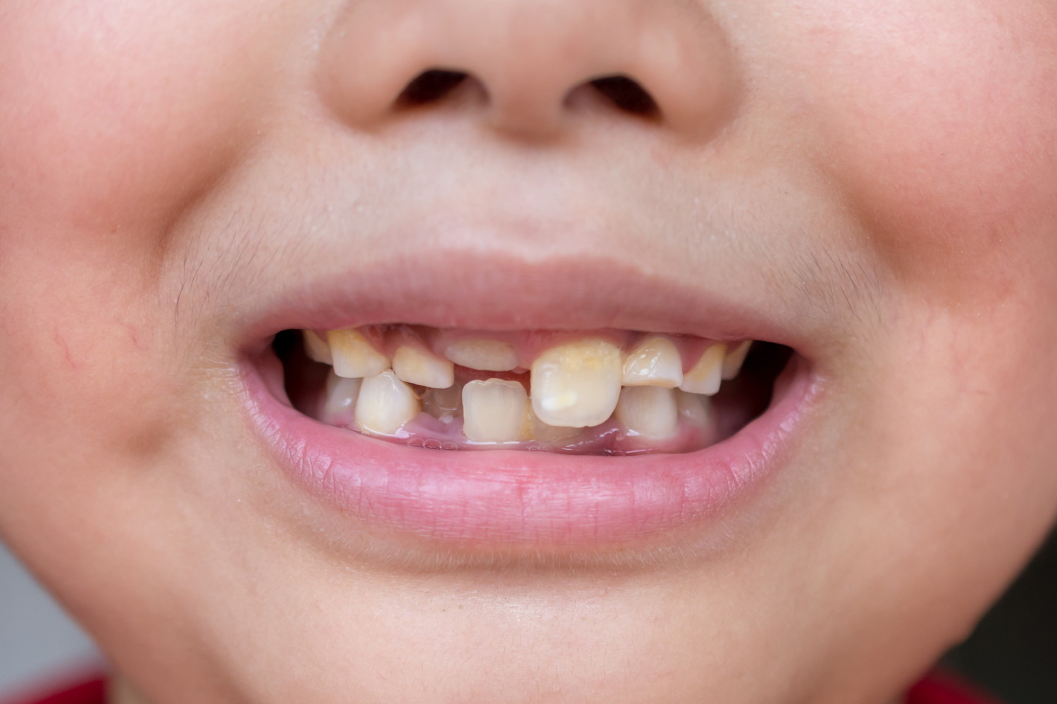Врожденная агенезия зубов связана с шестью видами онкозаболеваний