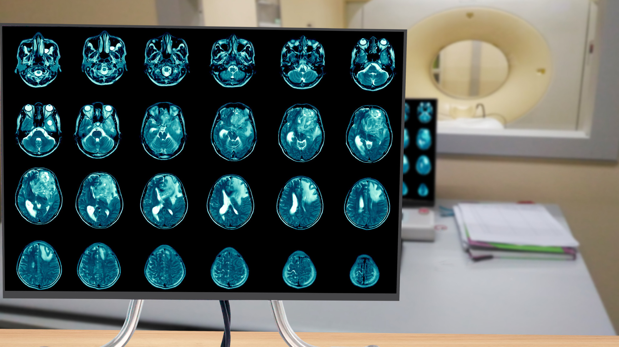 Ингибиторы протонной помпы ухудшали выживаемость у пациентов с глиобластомой