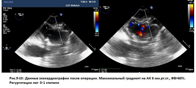 Операция на сердце с синдромом марфана