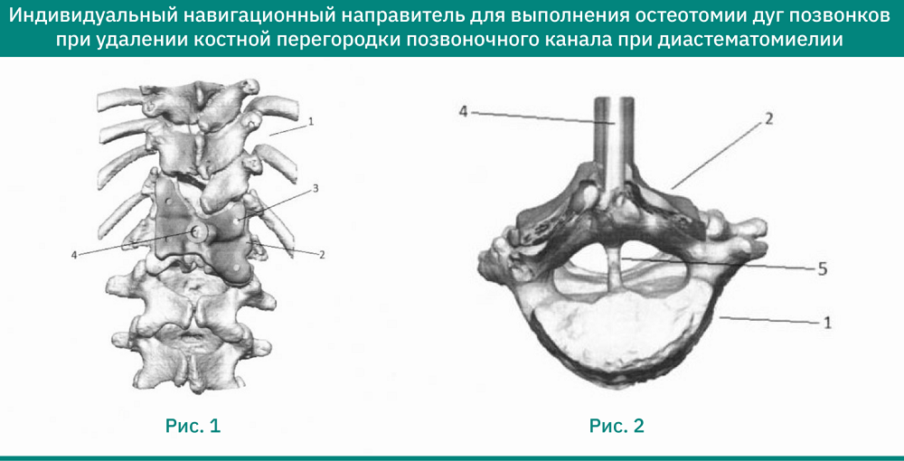 individualnyy-navigatsionnyy-napravitel-dlya-vypolneniya-osteotomii-dug-pozvonkov.png (227 KB)